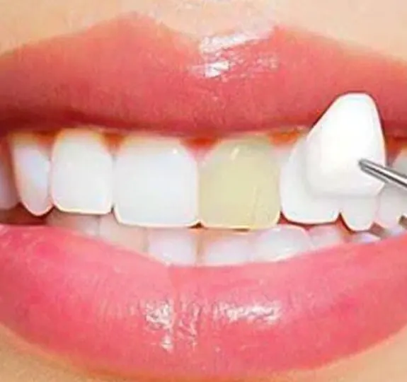 Tooth-colored restoration being placed on a discolored front tooth