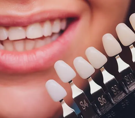 Porcelain veneer shade samples beside a smile