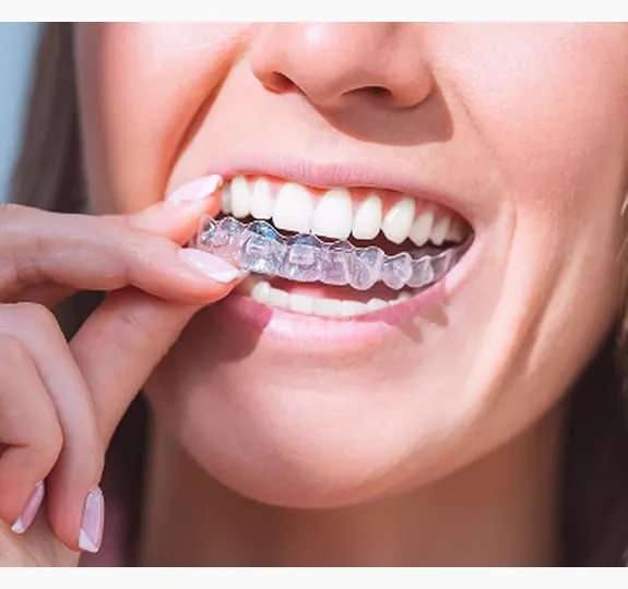 Person fitting a clear aligner over their teeth