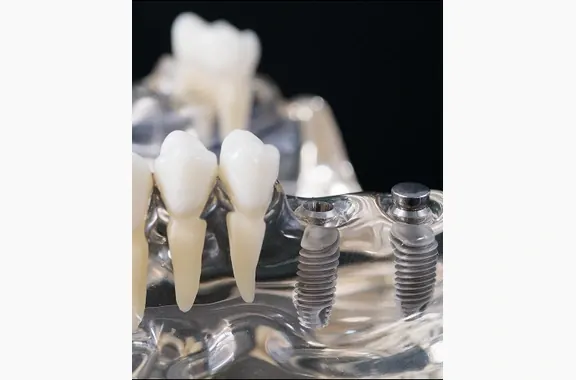 Close-up of a dental model with natural teeth and implant posts